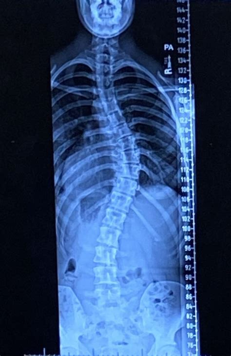 twists and curves spinal analysis and the correction of scoliosis