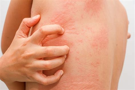 remédios caseiros para aliviar os sintomas da alergia dicas e receitas
