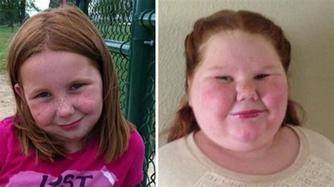 girl with rare weight gain disorder raises money for gastric bypass