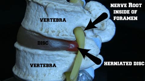sacroiliac joint pinched nerve