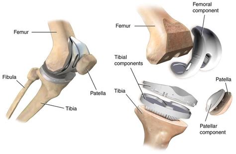 12 Components Of Total Knee Prosthesis [21] Download