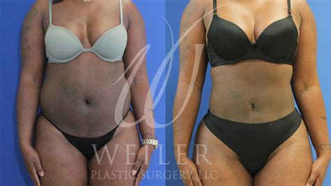 brazilian butt lift before and after photos patient 660