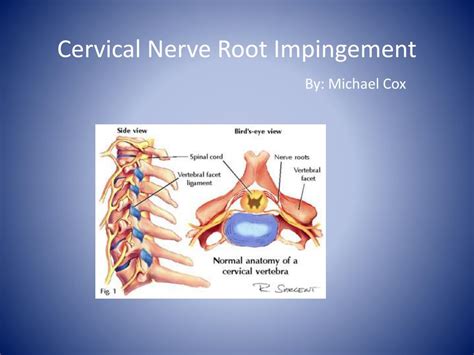 cervical nerve root impingement  michael  powerpoint