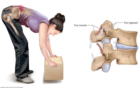 What Are The Causes Of A Low Back Sprain And Low Back Strain