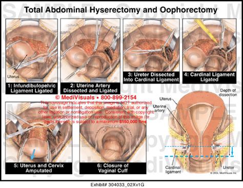 total abdominal hysterectomy and oophorectomy medivisuals
