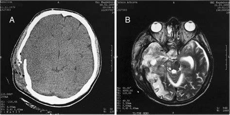 Y O Patient With Traumatic Brain Injury A Ct Scan Only Shows