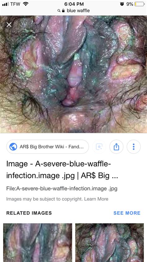 Blue Waffles Disease Wikipedia Quotes Update