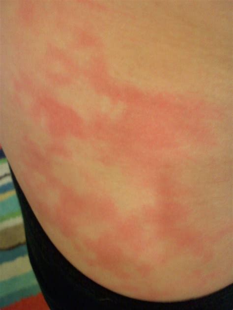 red blotchy rash pictures