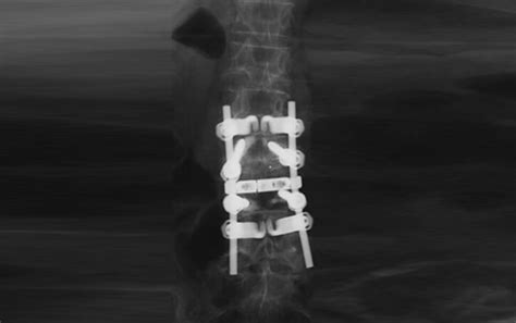 What Is Lumbar Fusion Premia Spine