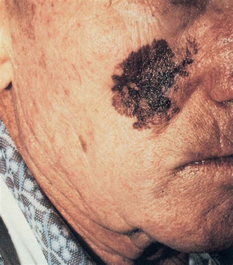 common types  skin cancer