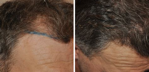 graft hair transplant coverage results costs