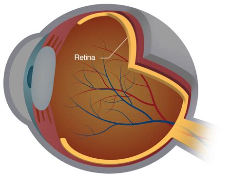 retinal tear  retinal detachment monterey ca salinas king city