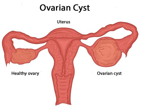 What Causes Ovarian Cysts And How Are They Treated