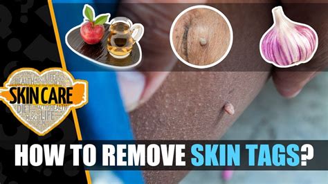 skin tag removal how to remove skin tags home remedies to remove