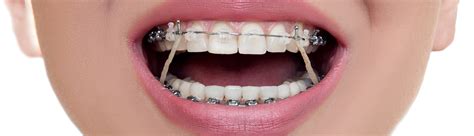 elastics  separators brisbane greater springfield orthodontics