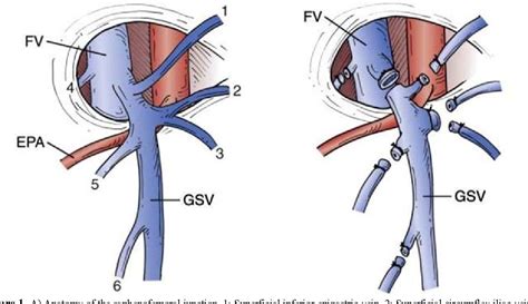 figure   anatomical variations   saphenofemoral junction  patients  varicose