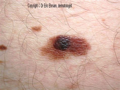 dermoscopy superficial spreading melanoma