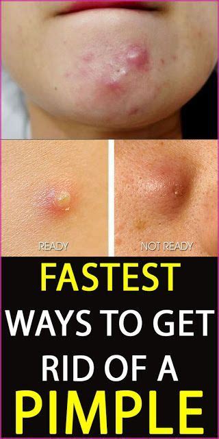 10 ways to get rid of a pimple overnight in 2020 how to