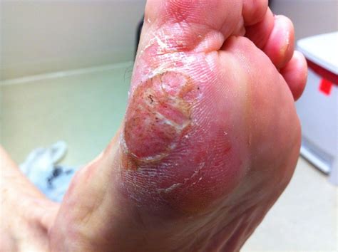 plantar warts healthmark foot and ankle associates