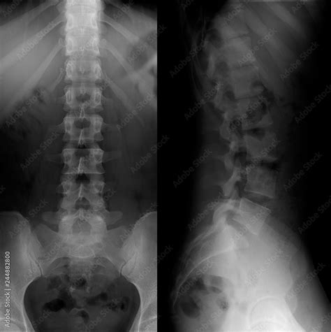 ray   lumbosacral spine normal perfect stock photo adobe stock