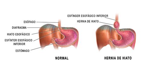 hernia de hiato hernia hiatal síntomas causas y tratamiento
