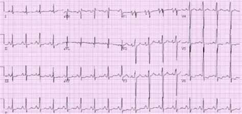 Electrocardiogram Showing Abnormal St T Wave Biatrial Open I