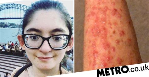 Girl Has Butterfly Skin Which Falls Off If She Walks Longer Than 10