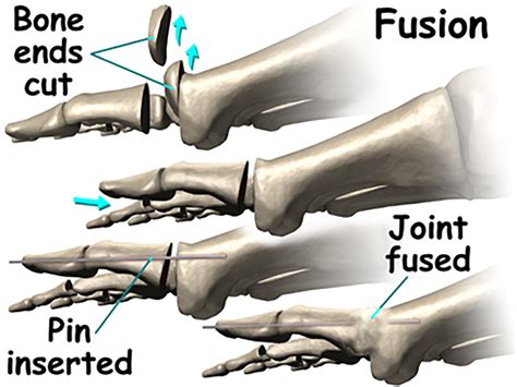 storm anesthesia  stiff big toe joint hallux rigidus