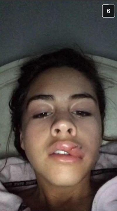 the kylie jenner lip challenge has turned into a complete disaster 19