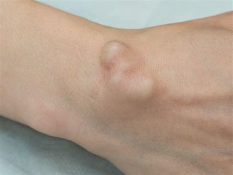 ganglion cyst excellence medical clinic