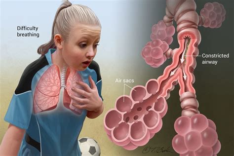 bronchial asthma lets breathe  ease