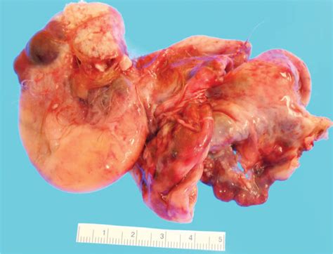 cancers ovarian fallopian tube and primary peritoneal obgyn key