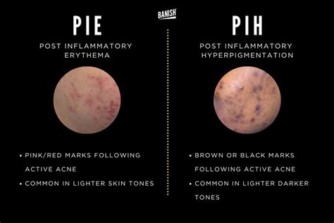 pie  pih acne marks whats  difference treatments banish