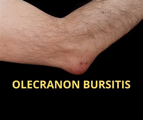 olecranon bursitis treatment london elbow surgeon