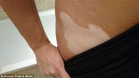 Vitiligo Sufferer Reveals How Instagram Gave Her Confidence To Flaunt