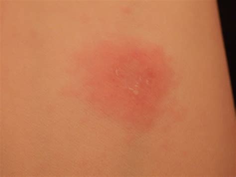 dozen red  itchy bumps     legs     itch