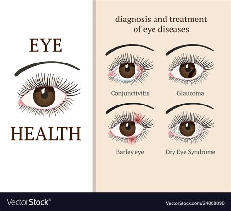 common eye problems royalty  vector image