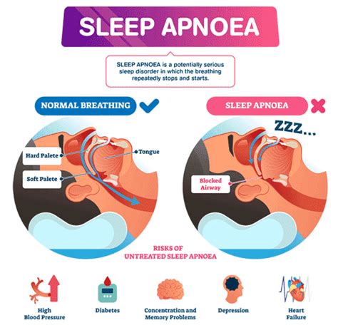 Sleep Apnoea Knowledge Centre Sleep Apnoea Diagnosis And Treatment