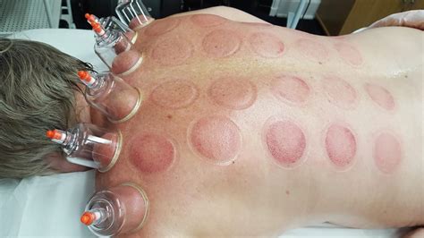chinese cupping treatment shen holistics