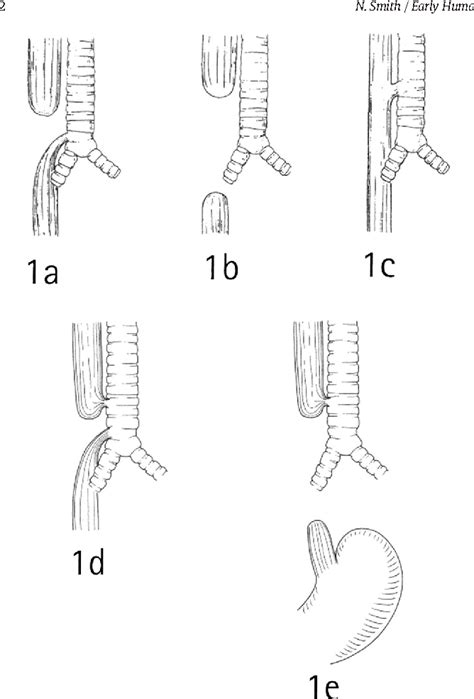 Figure 1 From Oesophageal Atresia And Tracheo Oesophageal Fistula