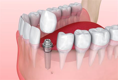 dental implant  single tooth replacement east honolulu hawaii kai