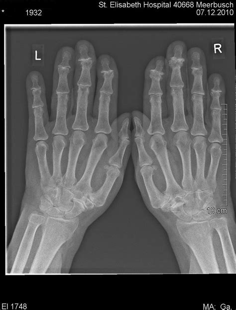rheumatologe arthrose roentgenbilder der haende osteoarthritis  rays  hands