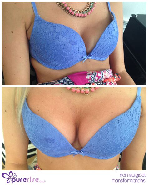 purerise non surgical breast enhancements