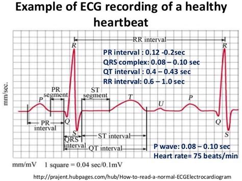 Electrocardiogram Ecg Or Ekg