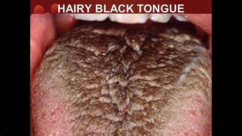 Do You Have Black Hairy Tongue Youtube