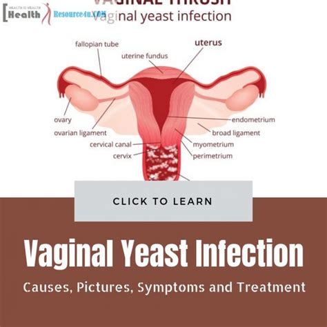 vaginal yeast infection causes picture symptoms and home remedies
