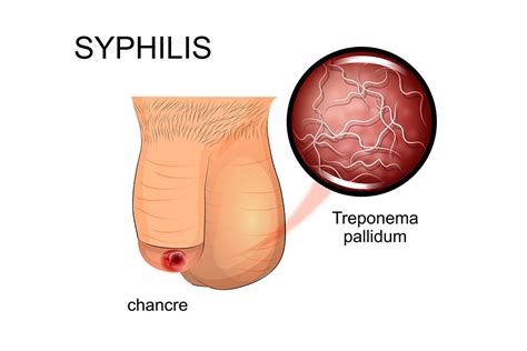 syphilis symptoms treatment and pictures syphilis std