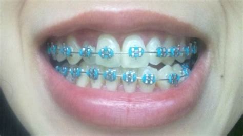 follow ya average girl for more pins aparelho ortodontico t