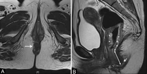 a axial t2w mri showing anal verge arrow b sagit open i