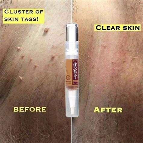 skin tag remover against mole and genital wart fast removwithin al anti